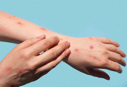 How to Prevent Monkeypox in Your Workplace